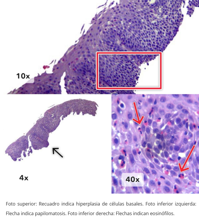 Esofagitis eosinofílica - Hiperplasia y eosinófilos