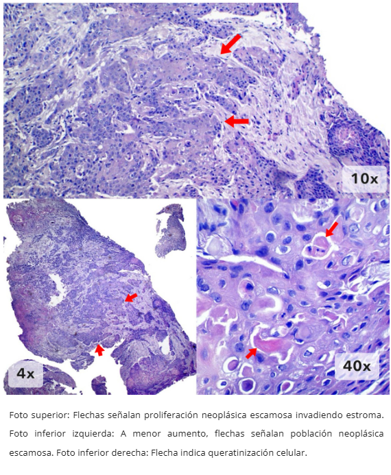 Imagen 3 de carcinoma escamoso