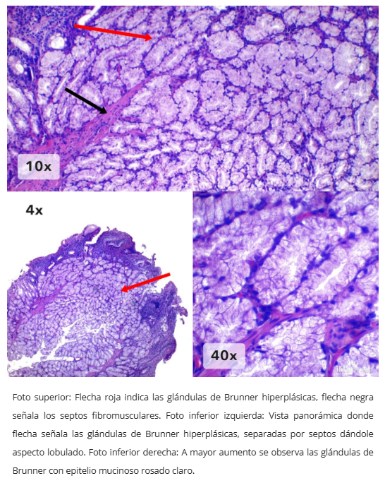 Hiperplasia de glándulas de Brunner