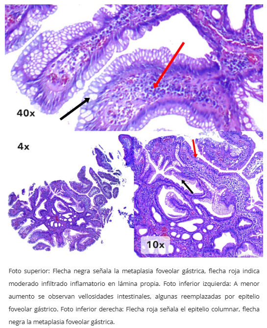 Pólipo inflamatorio