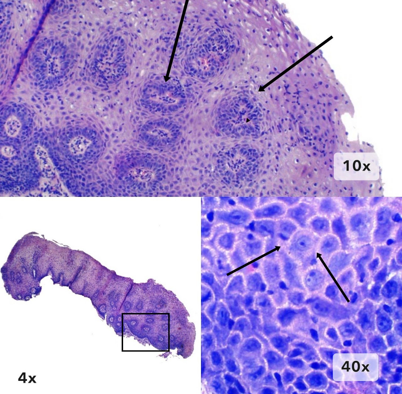Imagen 3 de esofagitis de reflujo