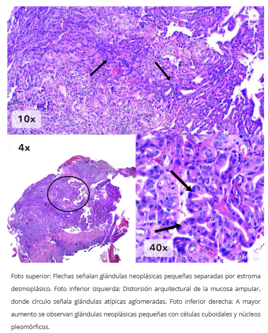 Tipo pancreatobiliar