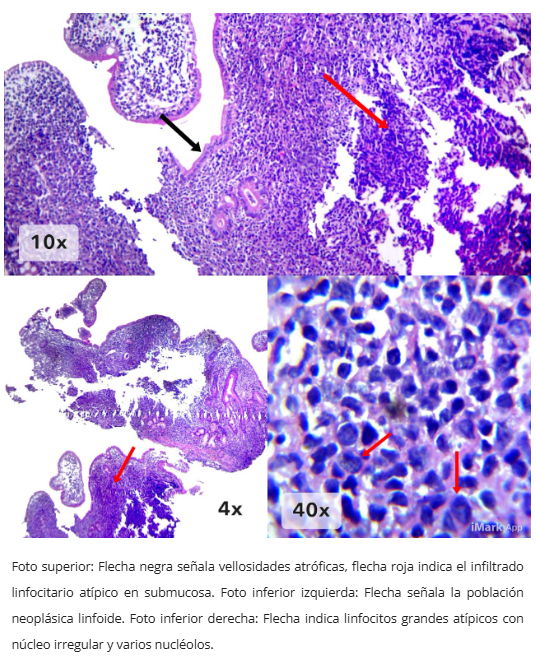 Inmunohistoquímica CD10