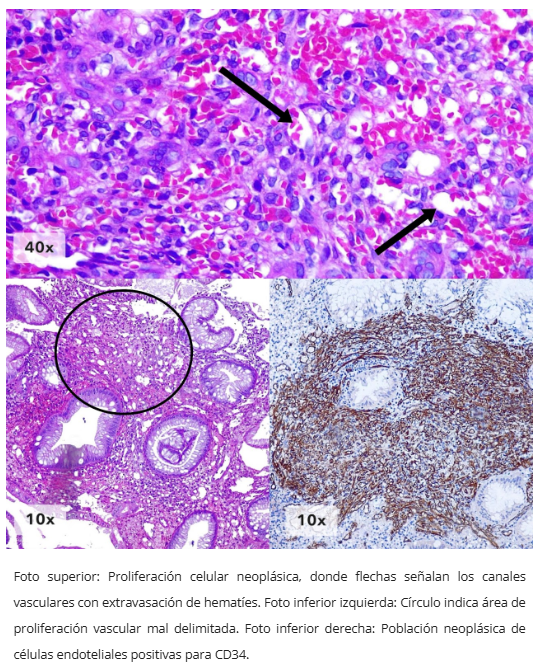 Inmunohistoquímica CD34