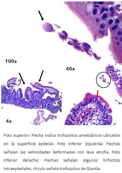 Patrón inflamatorio