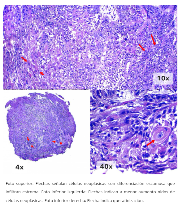 Imagen 4 de carcinoma escamoso