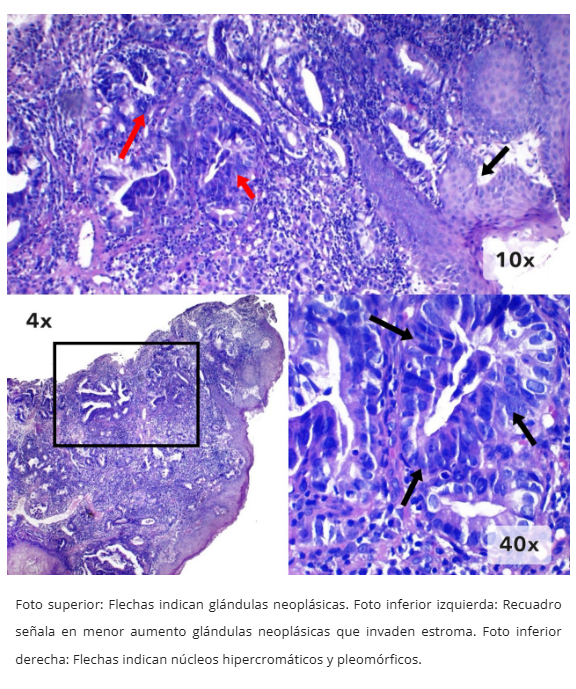 Imagen 4 de adenocarcinoma esofágico