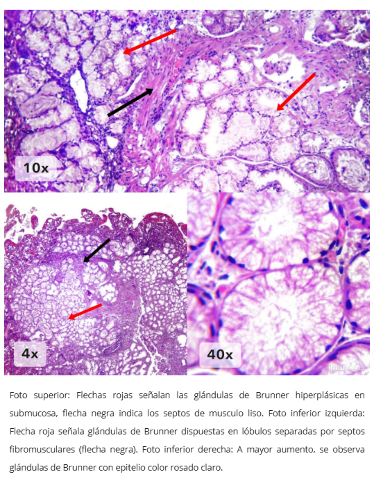 Hiperplasia de glándulas de Brunner