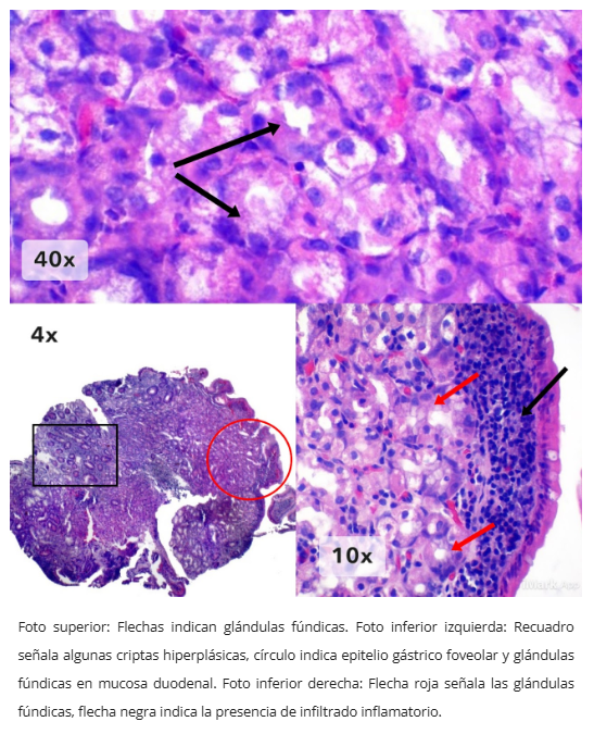 Mucosa gástrica heterotópica