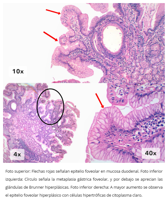 Pólipo inflamatorio