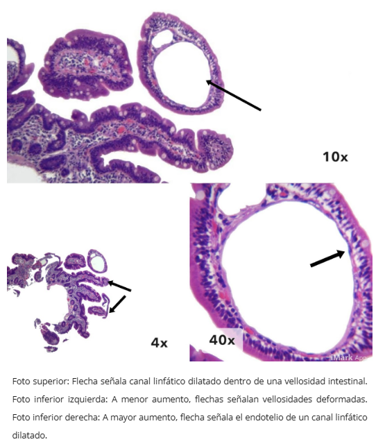 Linfagiectasia duodenal