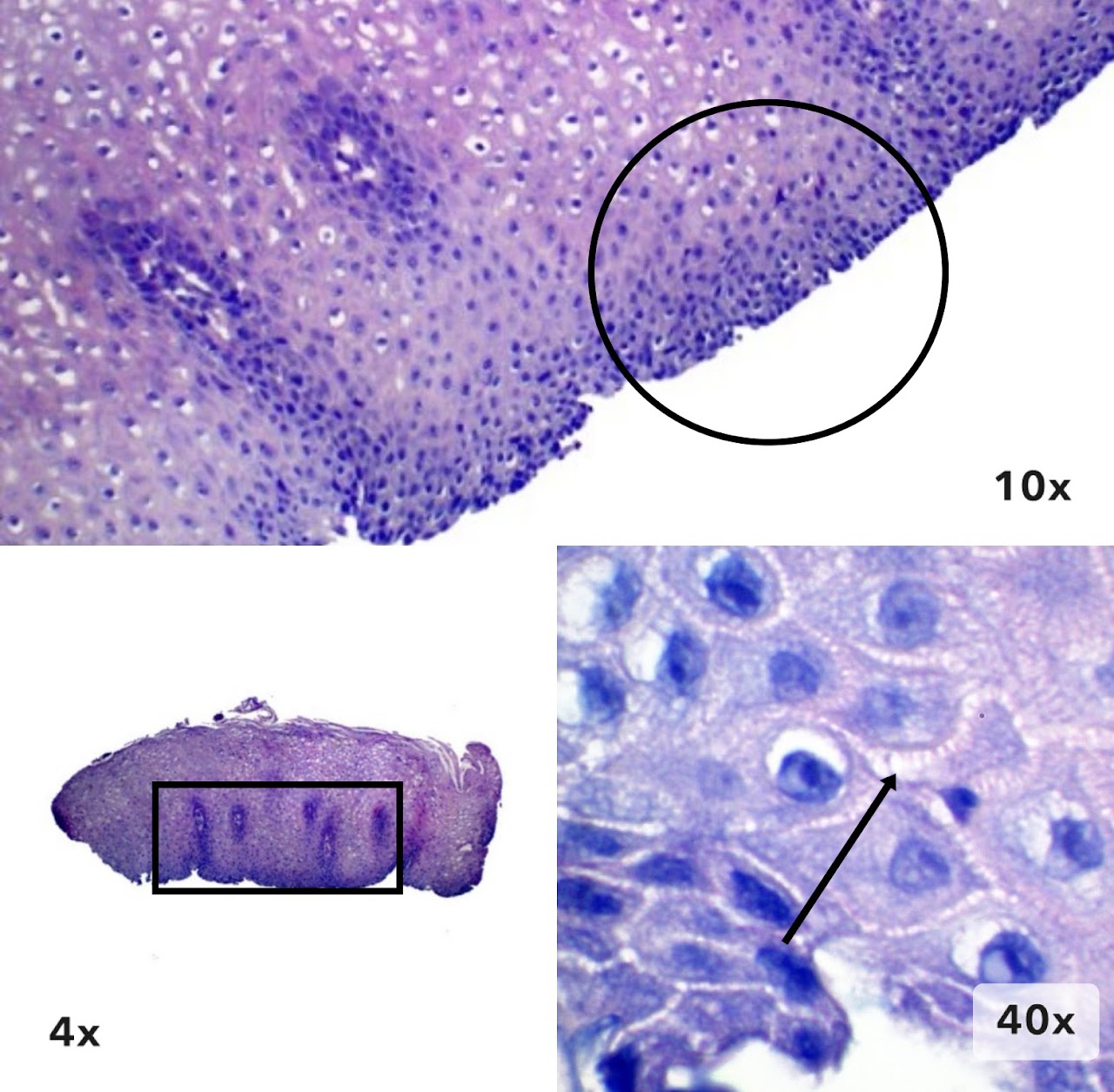 Imagen 4 de esofagitis de reflujo