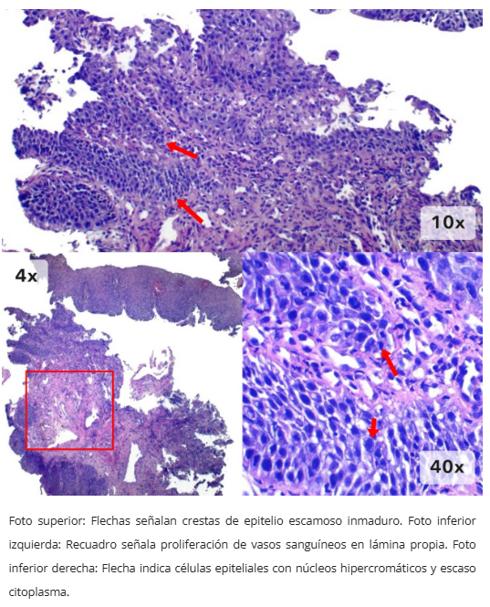 Inflamación asociada