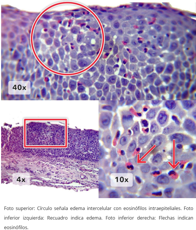Esofagitis eosinofílica - Eosinófilos y cambios epiteliales