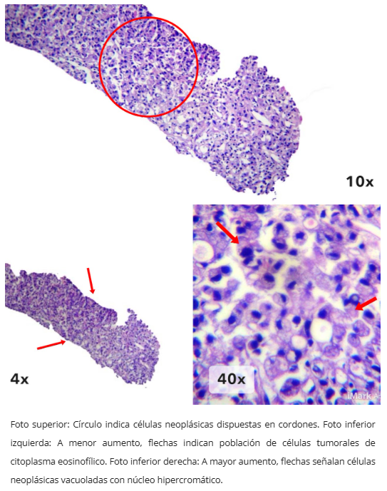 Hiperplasia foveolar adyacente