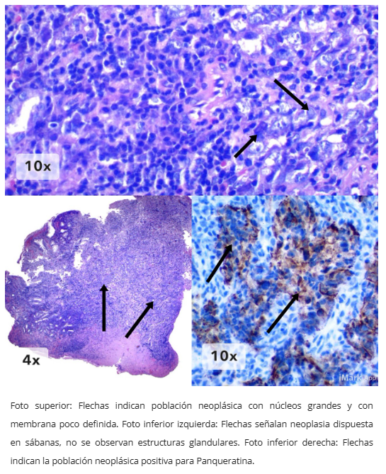 Inmunohistoquímica CD8