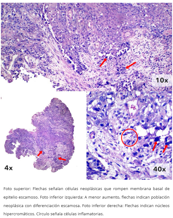 Imagen 5 de carcinoma escamoso