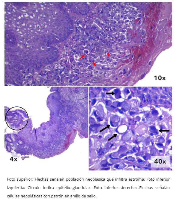 Imagen 5 de adenocarcinoma esofágico