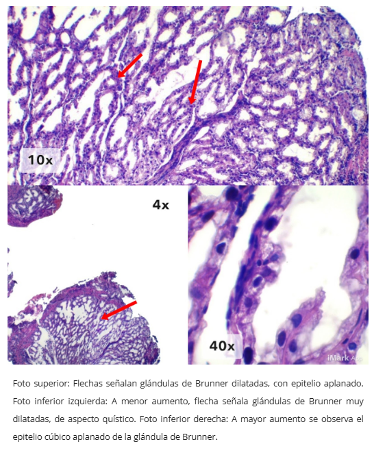 Hiperplasia de glándulas de Brunner