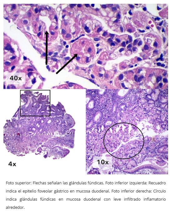 Mucosa gástrica heterotópica