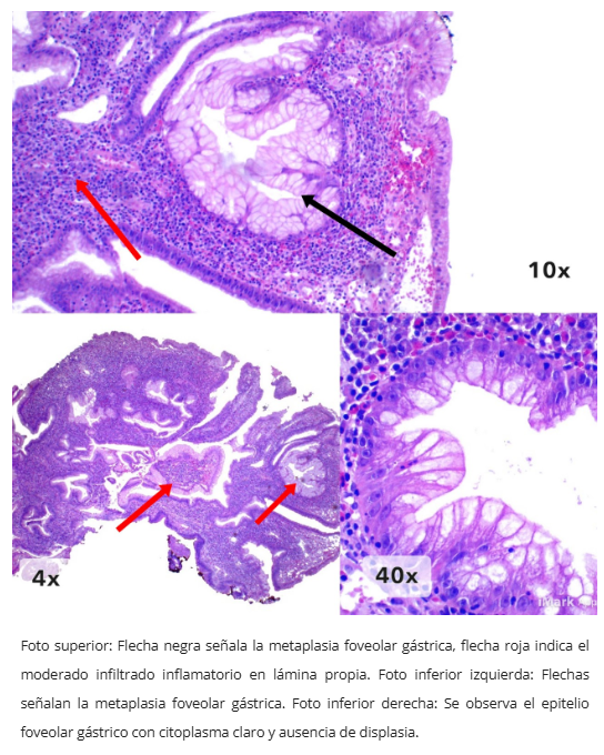 Pólipo inflamatorio