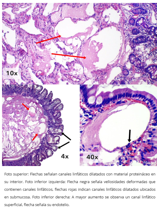 Linfagiectasia duodenal