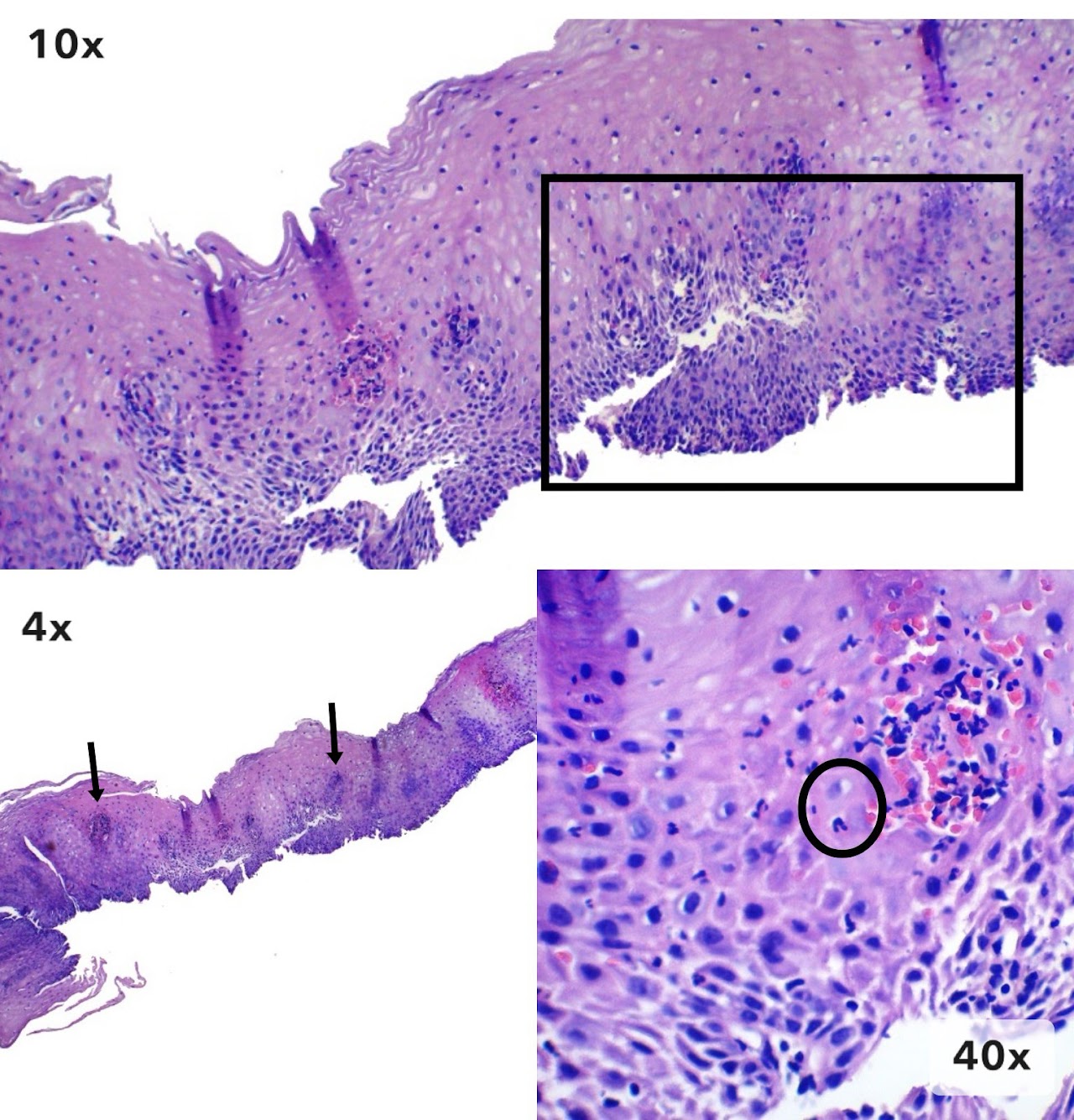 Imagen 5 de esofagitis de reflujo