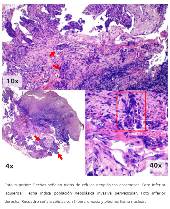 Imagen 6 de carcinoma escamoso