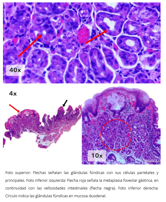 Mucosa gástrica heterotópica