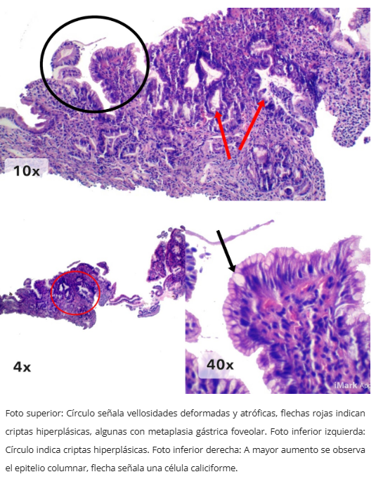 Pólipo inflamatorio