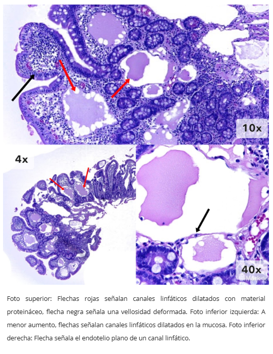 Linfagiectasia duodenal