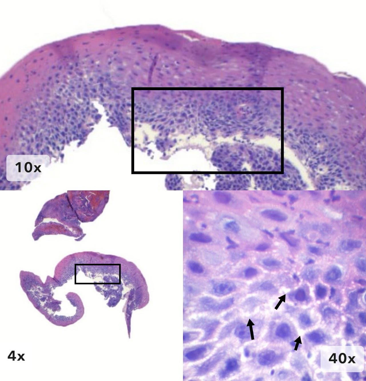 Imagen 6 de esofagitis de reflujo