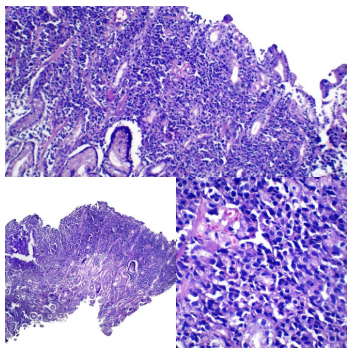 Inmunohistoquímica p53