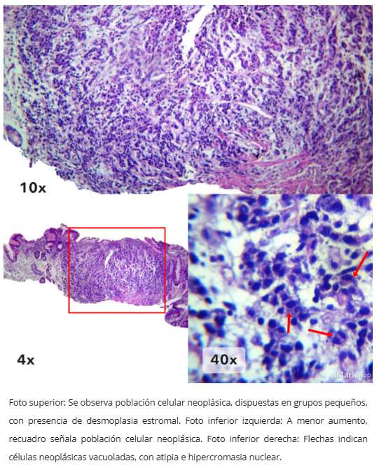 E-cadherina negativa