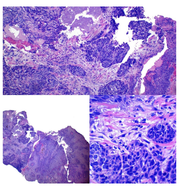 Imagen 7 de carcinoma escamoso