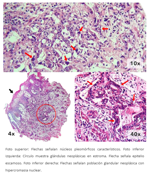 Imagen 7 de adenocarcinoma esofágico