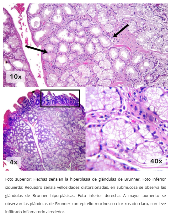 Hiperplasia de glándulas de Brunner