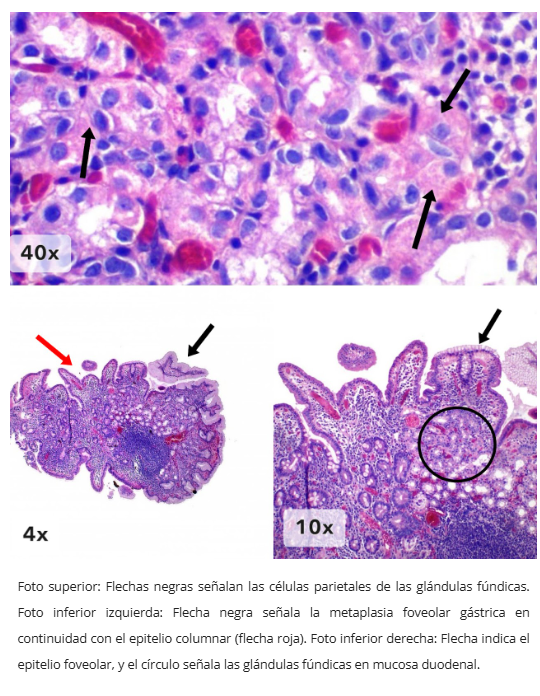 Mucosa gástrica heterotópica
