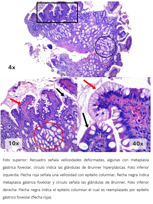 Pólipo inflamatorio