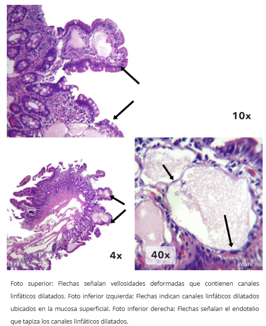 Linfagiectasia duodenal