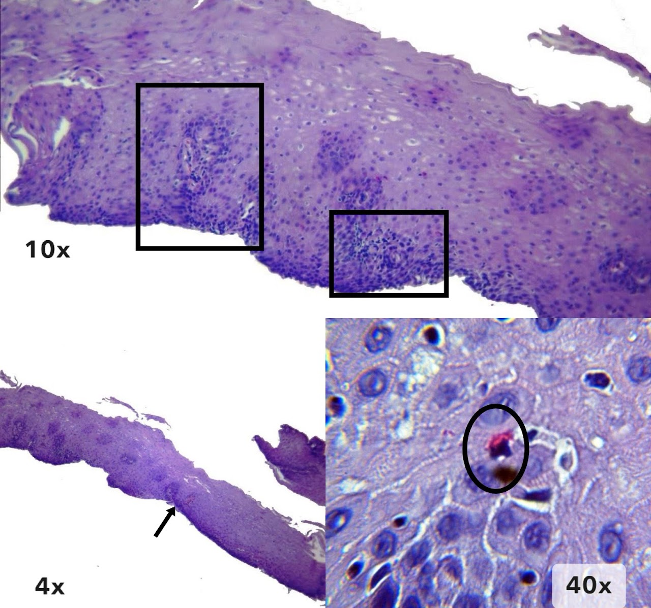 Imagen 7 de esofagitis de reflujo