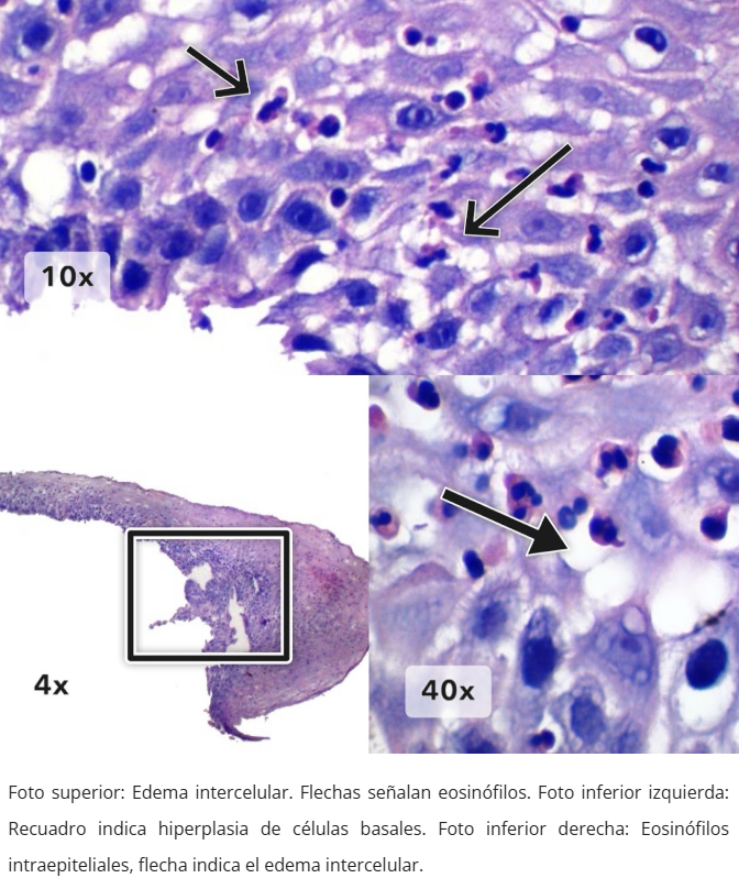 Esofagitis eosinofílica - Hiperplasia y eosinófilos