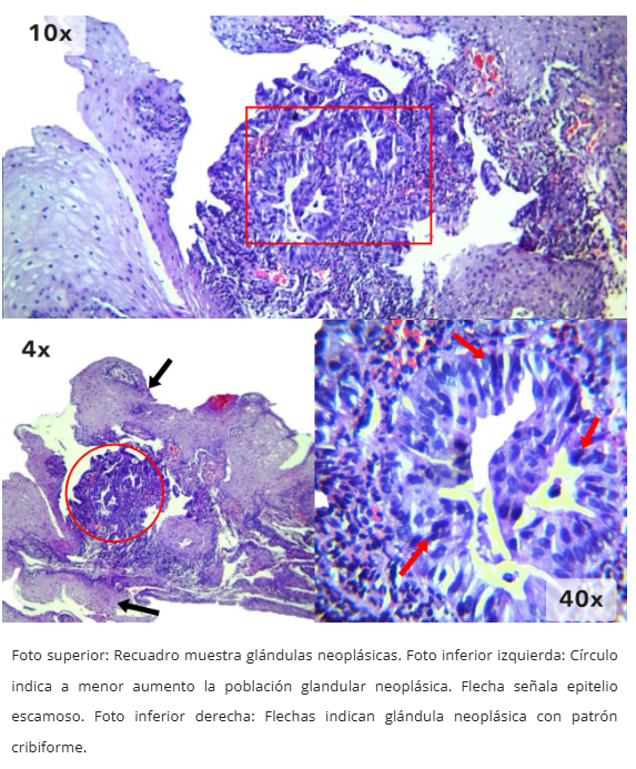 Imagen 8 de adenocarcinoma esofágico