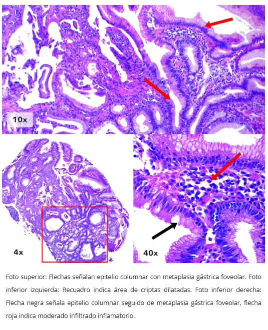 Pólipo inflamatorio