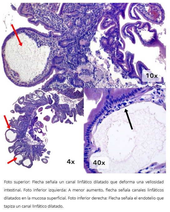 Linfagiectasia duodenal