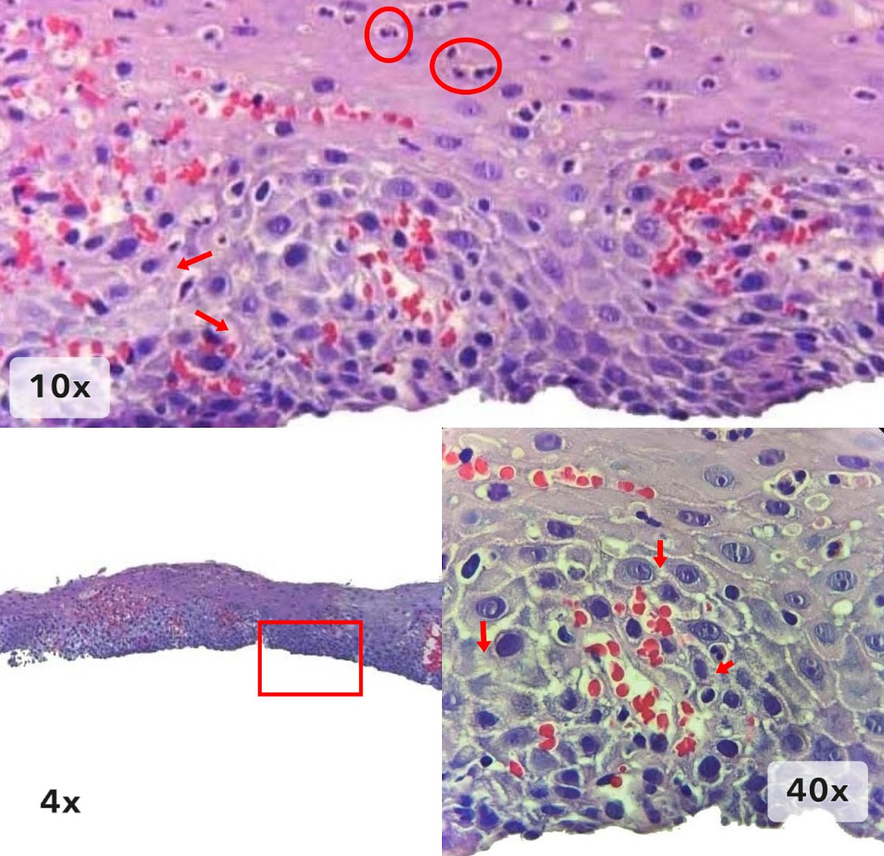 Imagen 8 de esofagitis de reflujo
