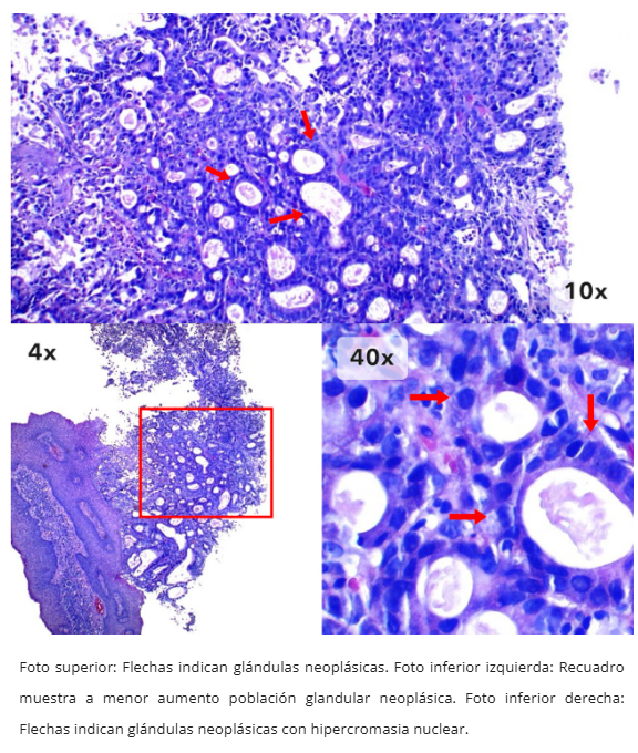 Imagen 9 de adenocarcinoma esofágico
