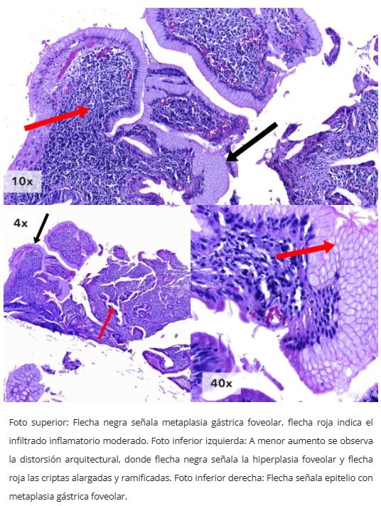 Pólipo inflamatorio