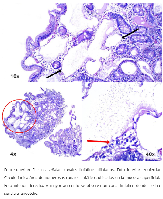 Linfagiectasia duodenal