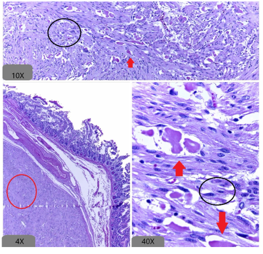 GIST metastásico